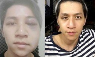 Ca sĩ Bùi Duy Ngọc chấn thương não, liệt nửa mặt vì tai nạn