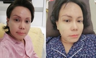 Việt Hương bị méo mặt, toàn thân phủ kín bởi 50 cây kim châm cứu